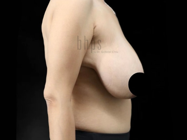 Case--5170 | Before Breast Reduction 2