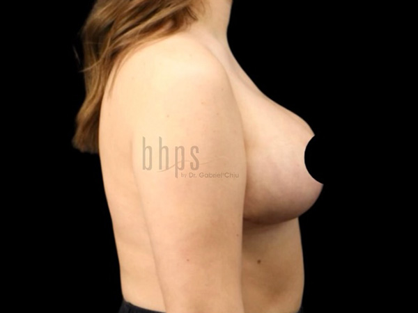 Case--9392 | After Breast Reduction 2
