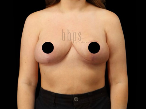 Case--9392 | After Breast