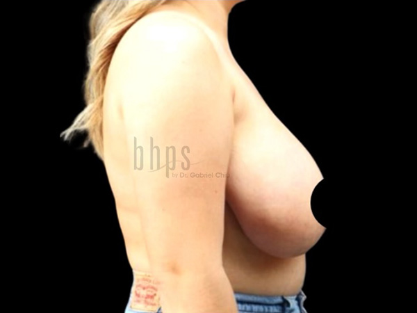 Case--9392 | Before Breast Reduction 2