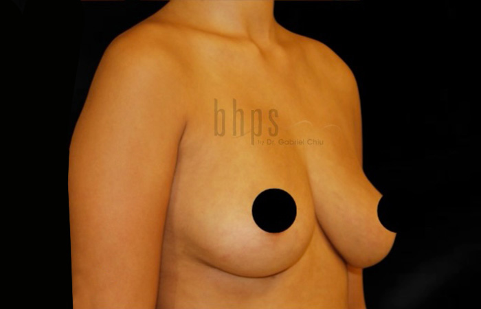 Breast Implants Removal & Replacement Patient After - 2