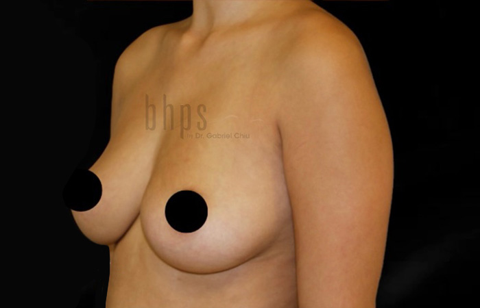 Case--6546 | After Breast Implant Removal 4