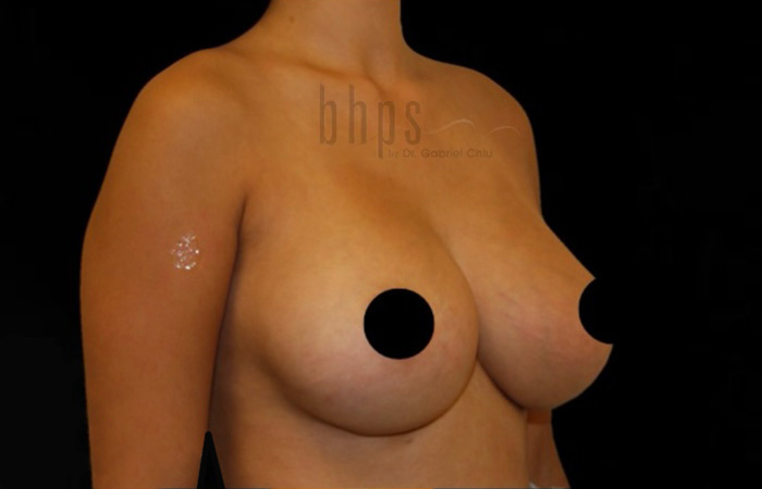 Breast Implants Removal & Replacement Patient Before - 2