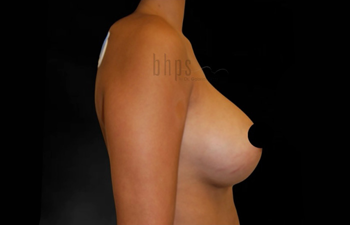 Case--6546 | Before Breast Implant Removal 3