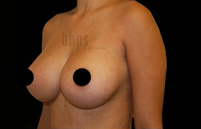 Case--6546 | Before Breast Implant Removal 4