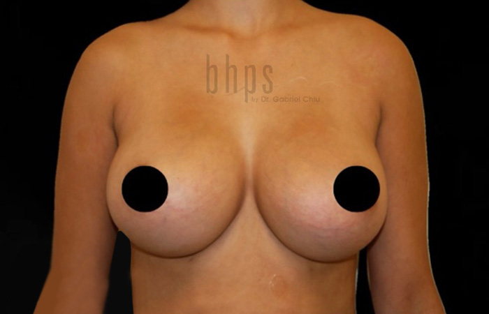 Breast Implants Removal & Replacement Patient Before - 1