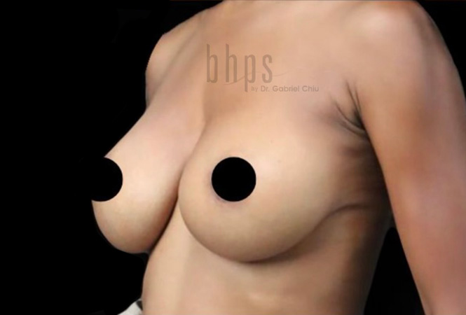 Case--9178 | After Breast Implant Removal and Replacement (Exchange) 2