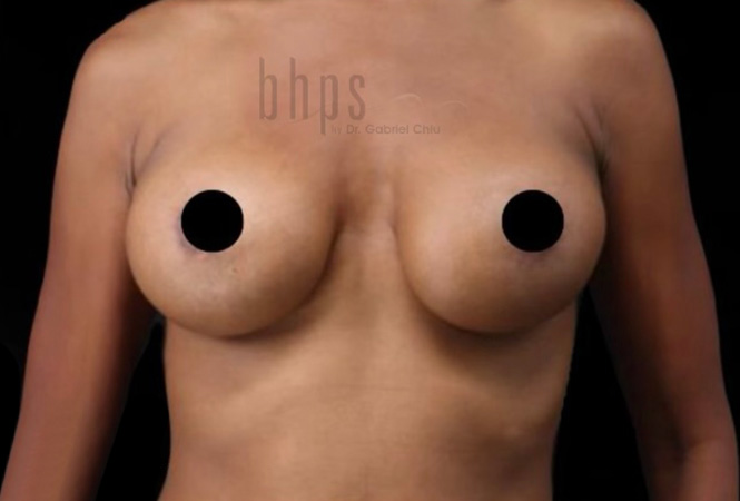 Case--9178 | Before Breast