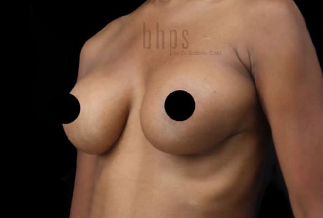 Case--9178 | Before Breast Implant Removal and Replacement (Exchange) 2