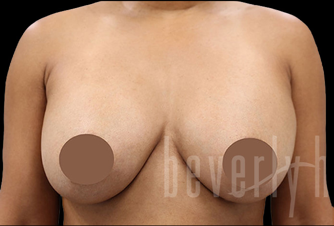 Case--2892 | Before Breast Implant Removal and Replacement (Exchange)