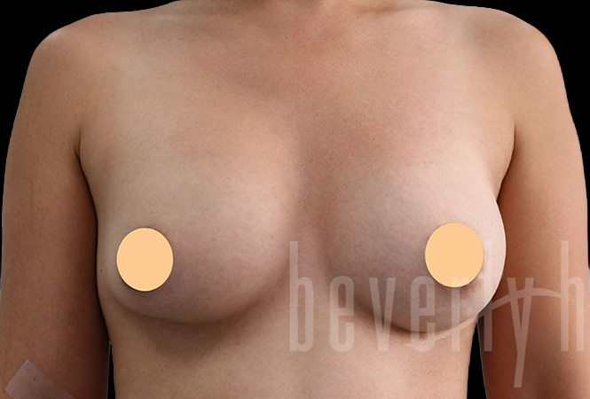 Case--7026 | Before Breast Implant Removal and Replacement (Exchange)