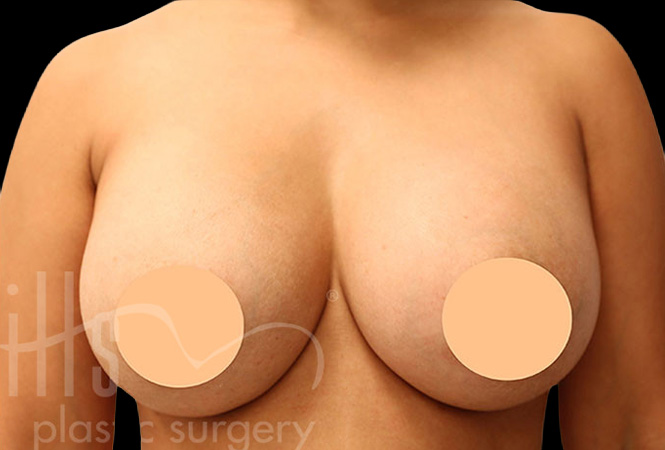 Case--2540 | After Breast Implant Removal and Replacement (Exchange)