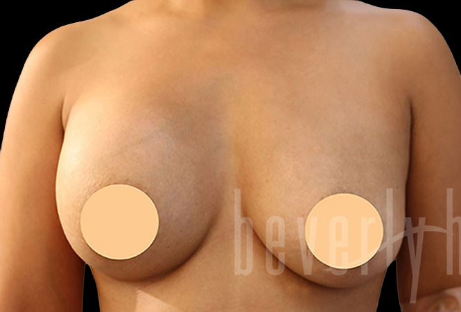 Case--2540 | Before Breast Implant Removal and Replacement (Exchange)
