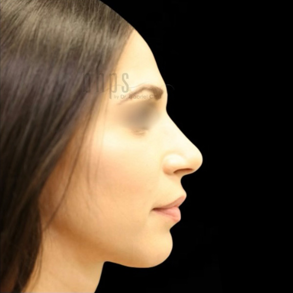 Rhinoplasty Patient After - 1