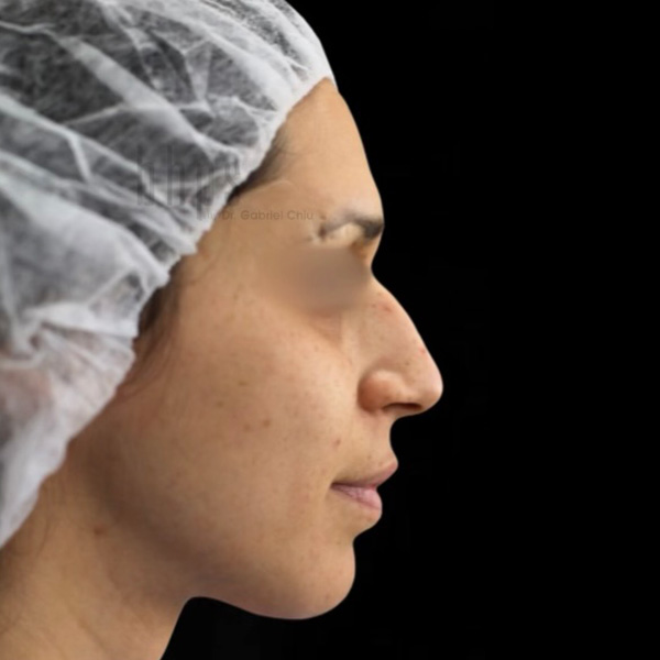 Rhinoplasty Patient Before - 1