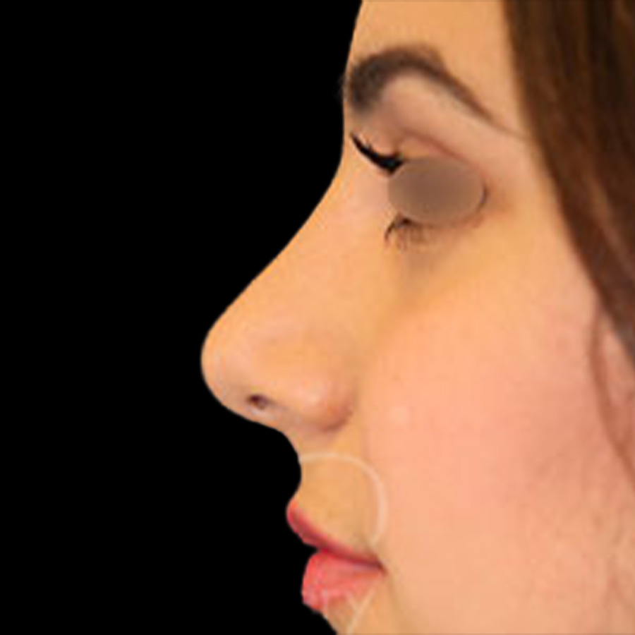 Case--7269 | After Face