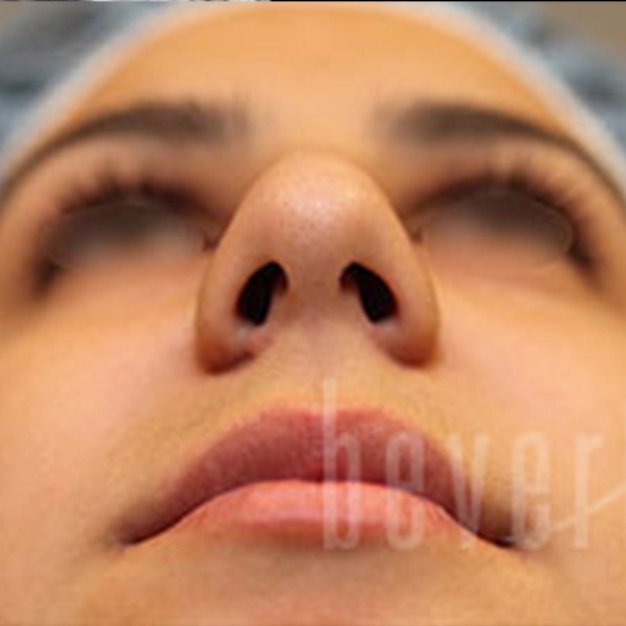 Case--7269 | Before Rhinoplasty 2