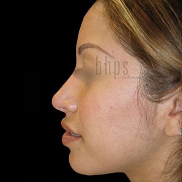 Case--2969 | After Face