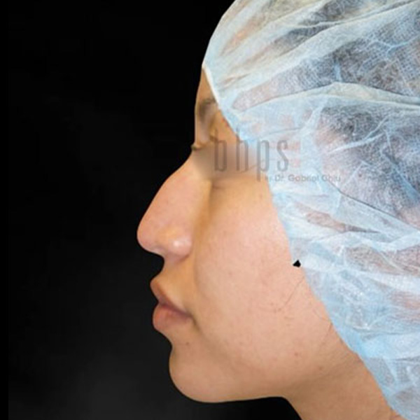 Case--2969 | Before Face