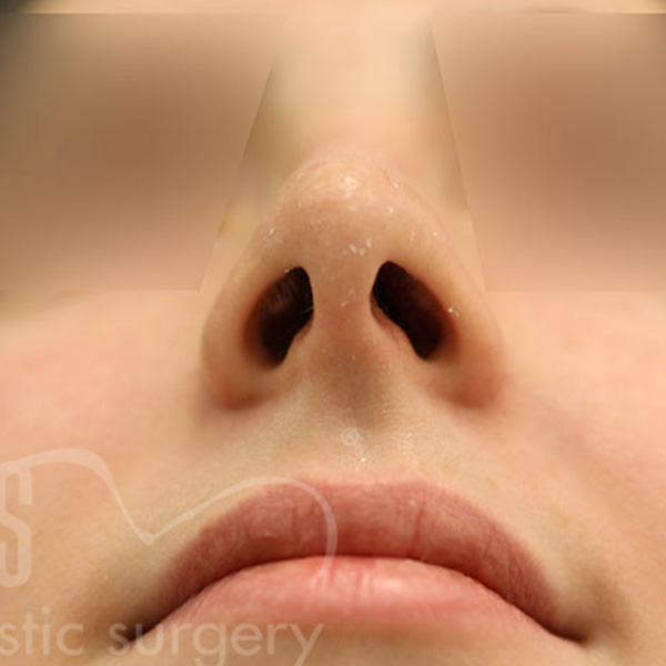 Case--4401 | After Rhinoplasty 2