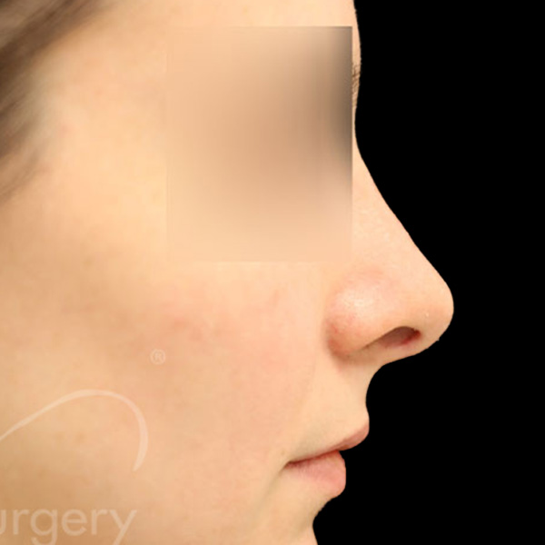 Case--4401 | After Face