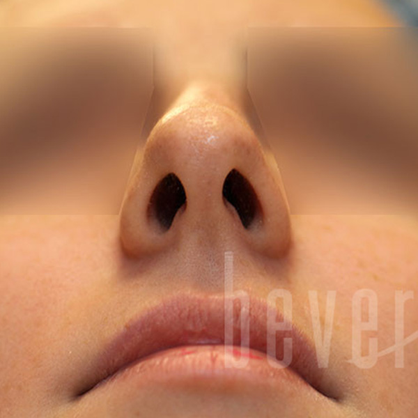 Case--4401 | Before Rhinoplasty 2