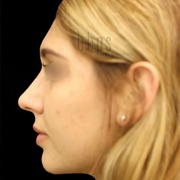 Case--5802 | After Rhinoplasty