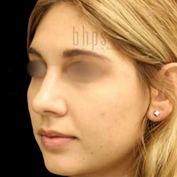 Case--5802 | After Rhinoplasty 3