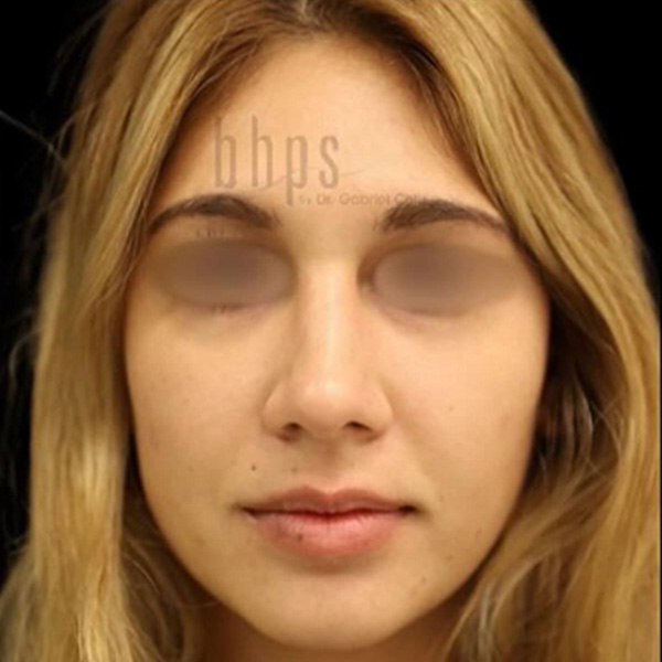 Case--5802 | After Rhinoplasty 2