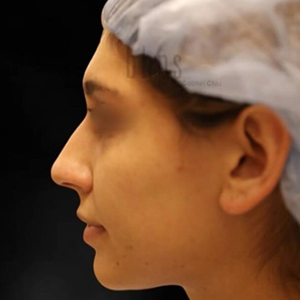 Case--5802 | Before Rhinoplasty