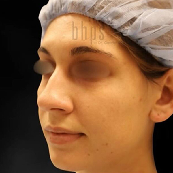 Case--5802 | Before Rhinoplasty 3