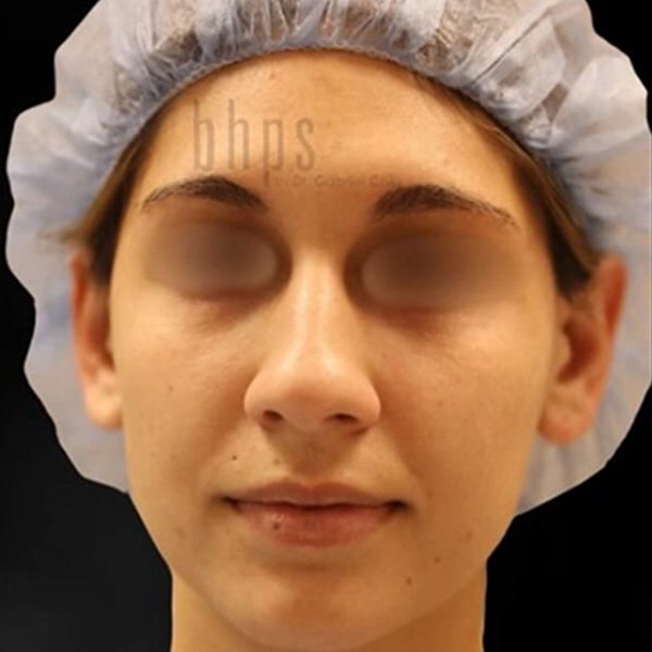 Case--5802 | Before Rhinoplasty 2