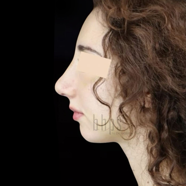 Case--9097 | After Face