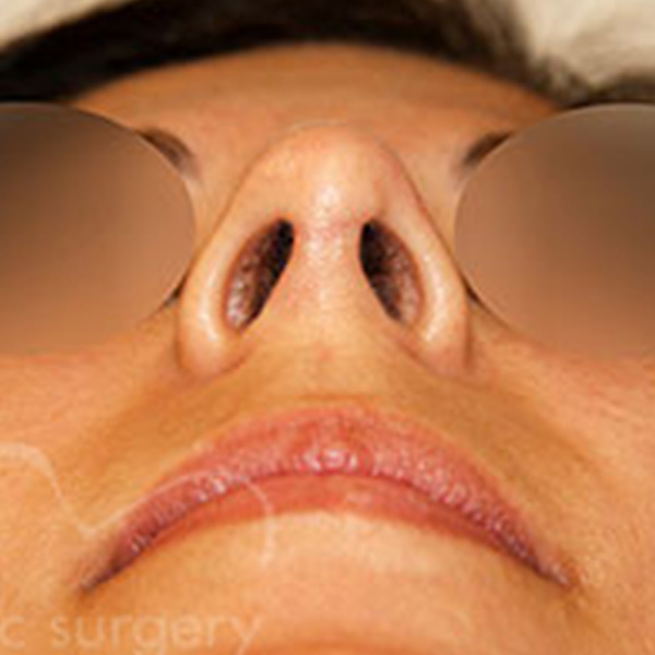 Case--6420 | After Rhinoplasty 2