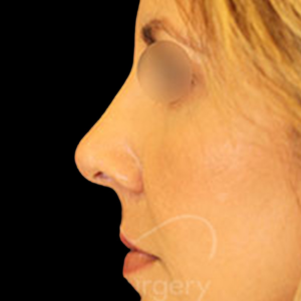 Case--9764 | After Face