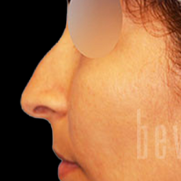 Case--6420 | Before Face