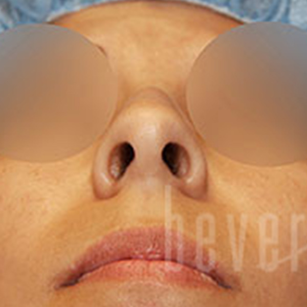 Case--6420 | Before Rhinoplasty 2