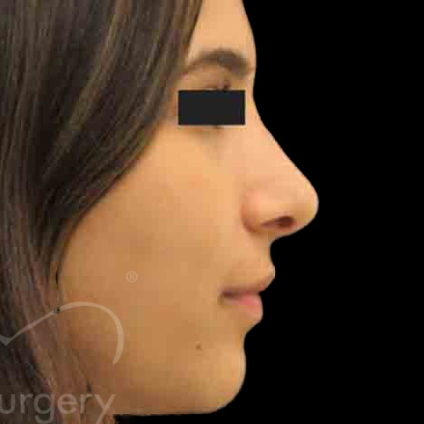 Case--9108 | After Face