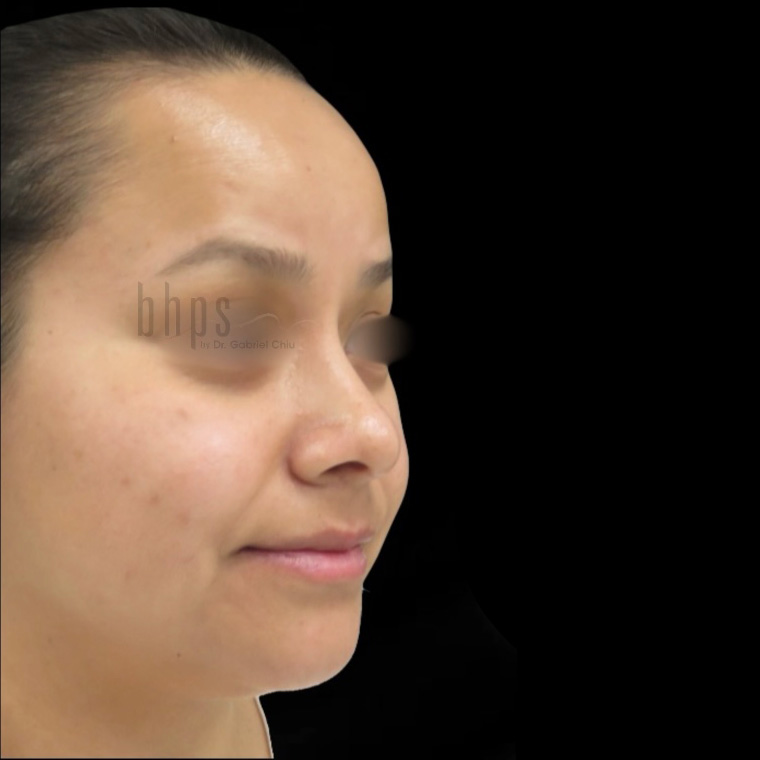 Case--6660 | After Rhinoplasty