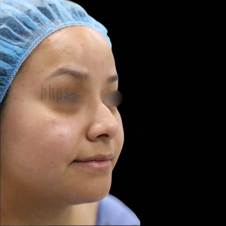 Case--6660 | Before Rhinoplasty