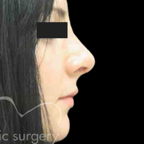 Case--9108 | After Rhinoplasty