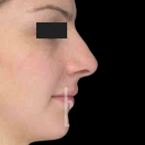 Case--9108 | Before Rhinoplasty
