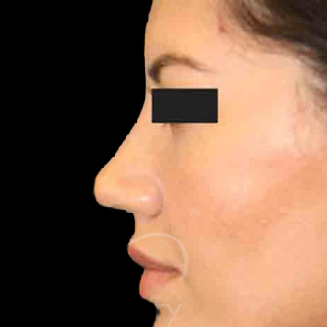 Case--8315 | After Rhinoplasty