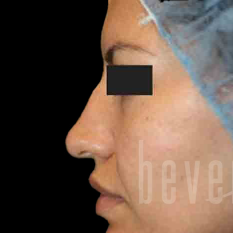 Case--8315 | Before Rhinoplasty