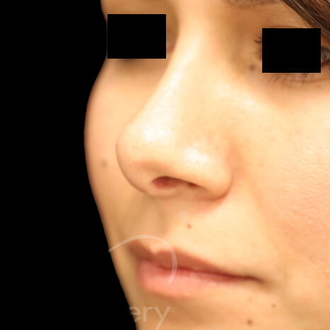 Case--5007 | After Rhinoplasty 2