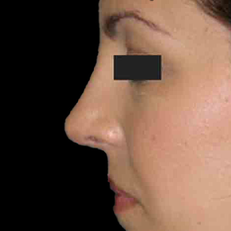 Case--6398 | After Rhinoplasty