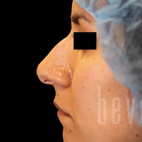 Case--5007 | Before Rhinoplasty