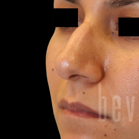 Case--5007 | Before Rhinoplasty 2