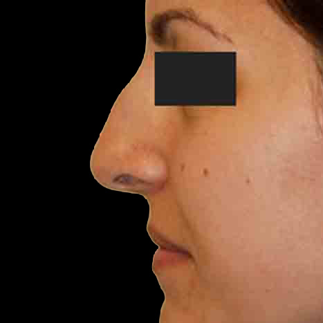 Case--6398 | Before Rhinoplasty