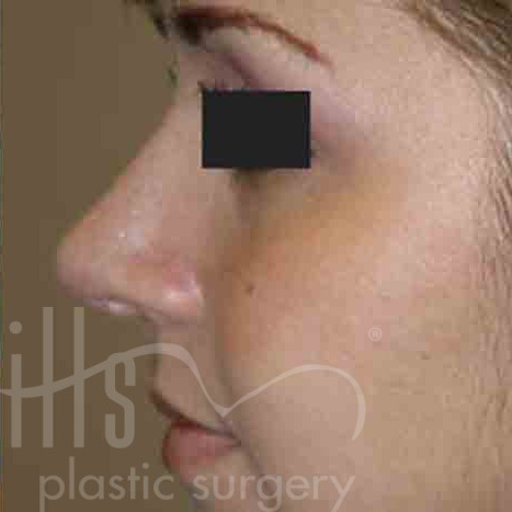 Case--1147 | After Face